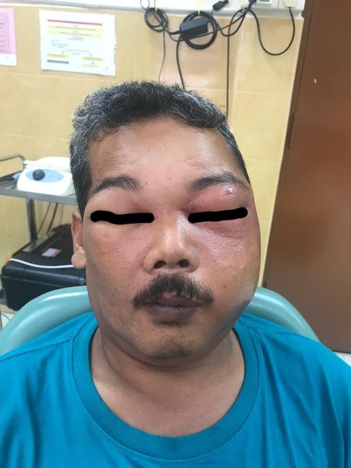 Sakit gigi malah pakai minyak rem jadi bengkak