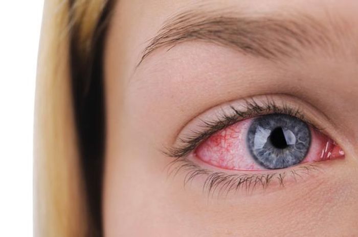 Jangan salah kaprah, gejala alergi dan Covid-19 beda. Mata merah bisa jadi alergi.