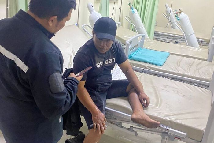 Kulit tangan Suparman (44), pemilik Daihatsu Terios yang terbakar di SPBU Nambo Jalan Raya Banjaran Barat, Desa Batukarut, Arjasari, Kabupaten Bandung, Jawa Barat, (11/8/25) melepuh