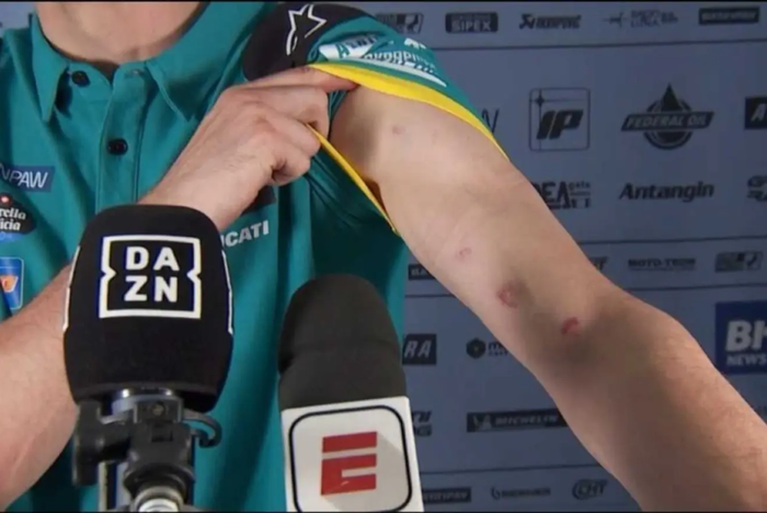 Alex Marquez menunjukan luka memar di tangan kirinya akibat terkelupasnya sirkuit Ayrton Senna di Brasil