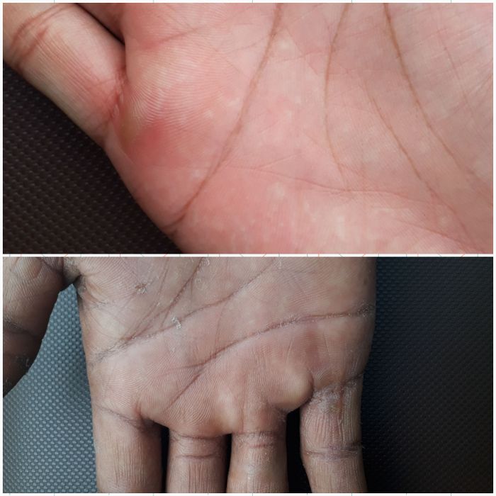 Telapak tangan yang mengalami kapalan