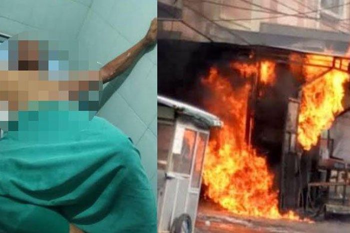 Kondisi Marsono (46), warga Jalan Sunan Giri, Desa Sidomukti, Kecamatan Kebomas yang mengalami luka bakar akibat tersambar api pom bensin mini yang terbakar. 