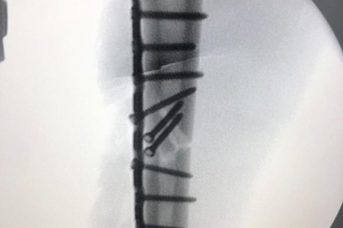 Foto rontgen patah tulang humerus Marc Marquez ditopang 12 sekrup dan pelat titanium