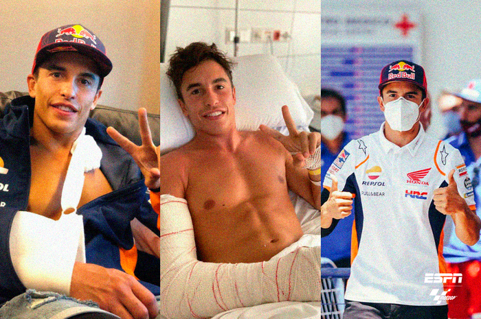 Unggah foto rontgen setelah dipasang 12 baut di tulang humerus kanan, Marc Marquez buktikan cedera yang dialaminya serius