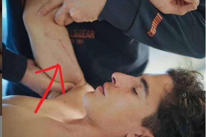 Pembalap Repsol Honda, Marc Marquez  sedang terapi pada lengan kanannya.