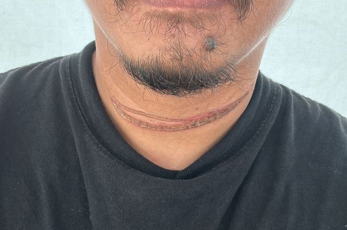 Luka di leher Dwi usai kejerat kabel optik menjuntai di Jalan Raya Bogor, Kramatjati, Jakarta Timur