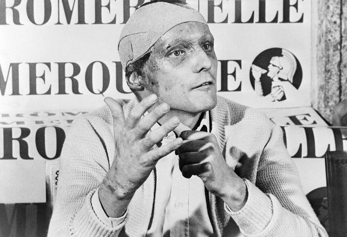 Niki Lauda kembali dengan bekas luka bakar di kepalanya