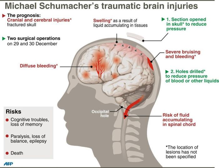 Begini ilustrasi yang menunjukkan kemungkinan cedera otak yang diderita Michael Schumacher