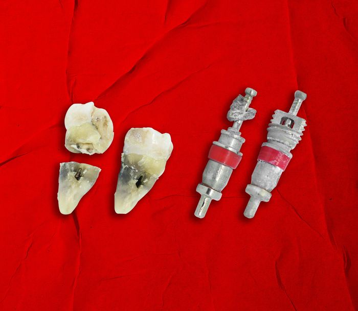Ibarat gigi, valve core pada pentil ban bisa patah akibat korosi bila sering kemasukan air akibat tidak pakai tutup pentil