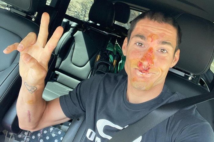 Aleix Espargaro dengan wajah penuh luka sebelum MotoGP Styria 2021