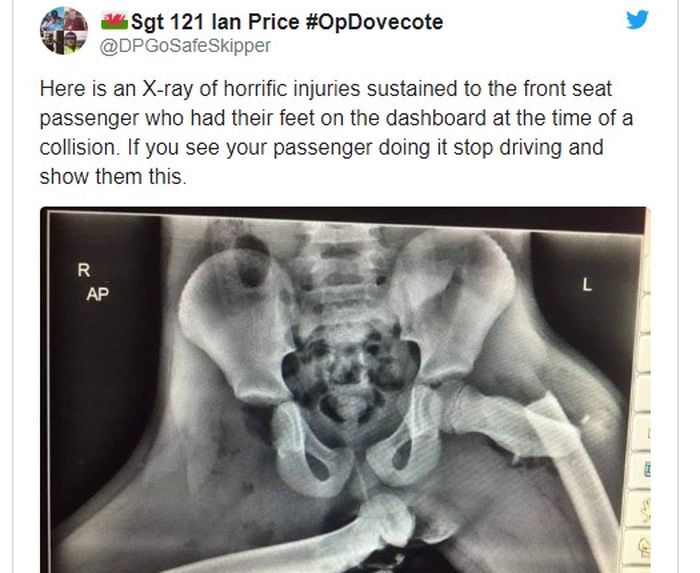 Foto X-ray Ini Buktikan Bahaya Meletakkan Kaki di Atas Dasbor Mobil