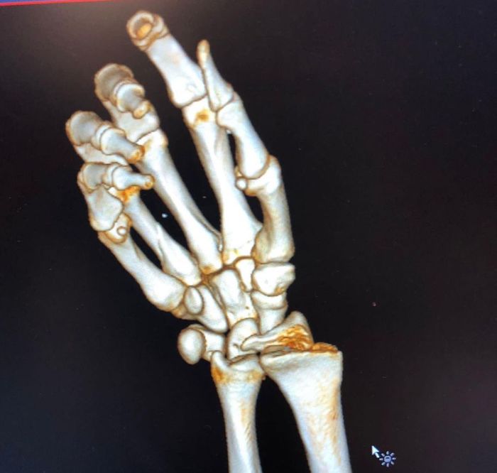 Dovizioso kemudian mengunggah foto pergelangan tangan dan hasil tes MRI melalui akun media sosial pribadinya